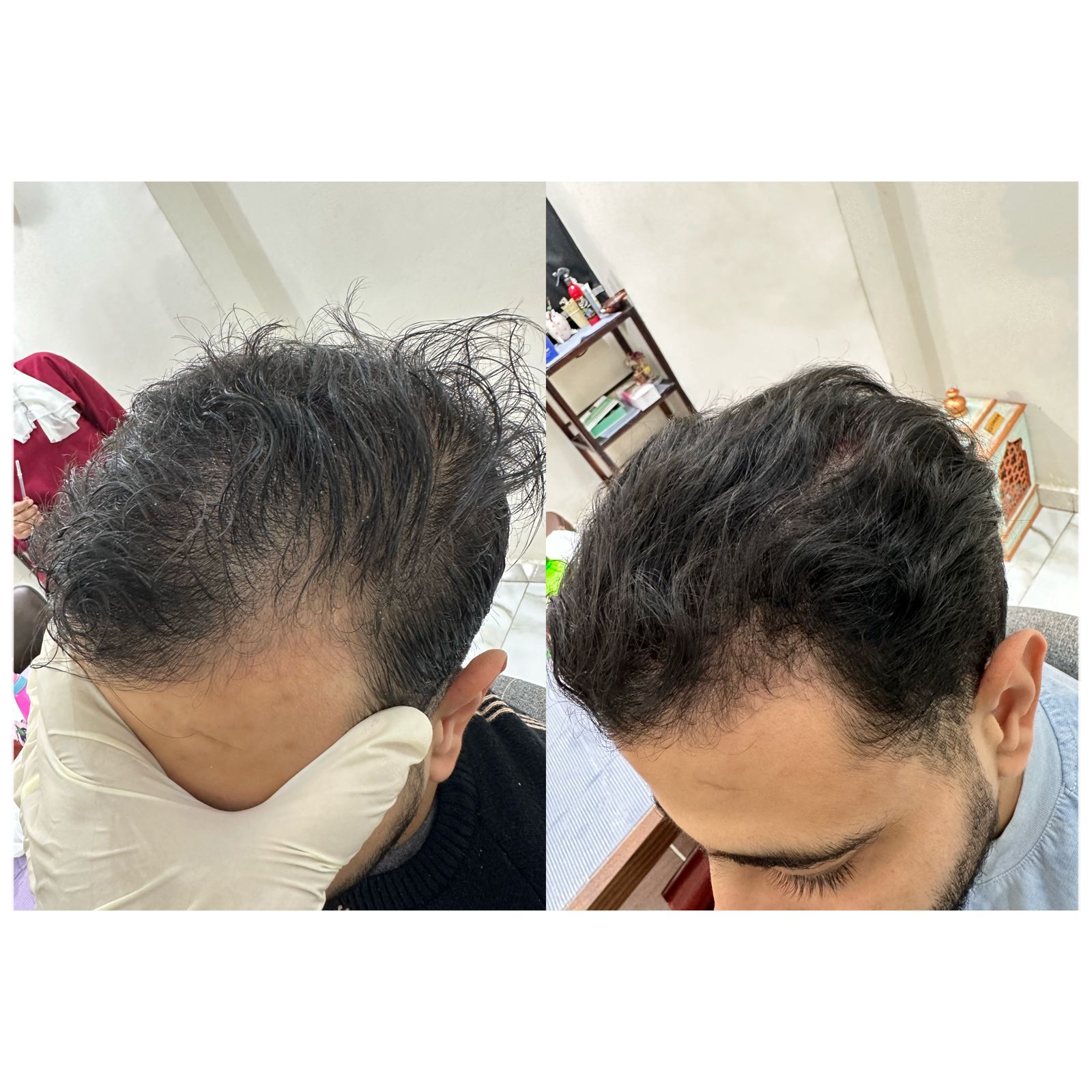 نتيجه جلسات الاكسوزوم للشعر