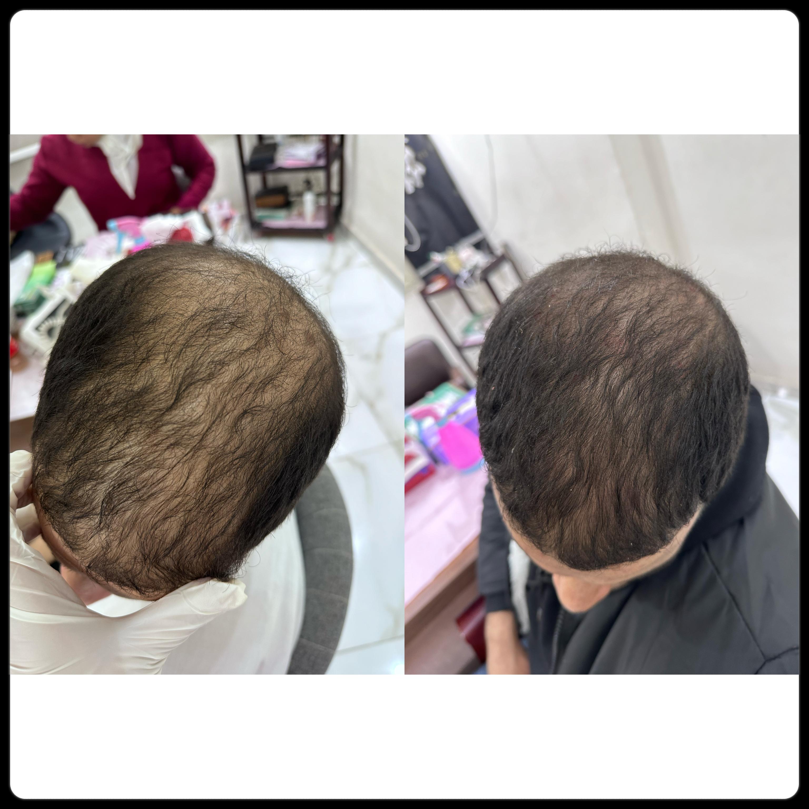 نتيجه جلسات الاكسوزوم للشعر