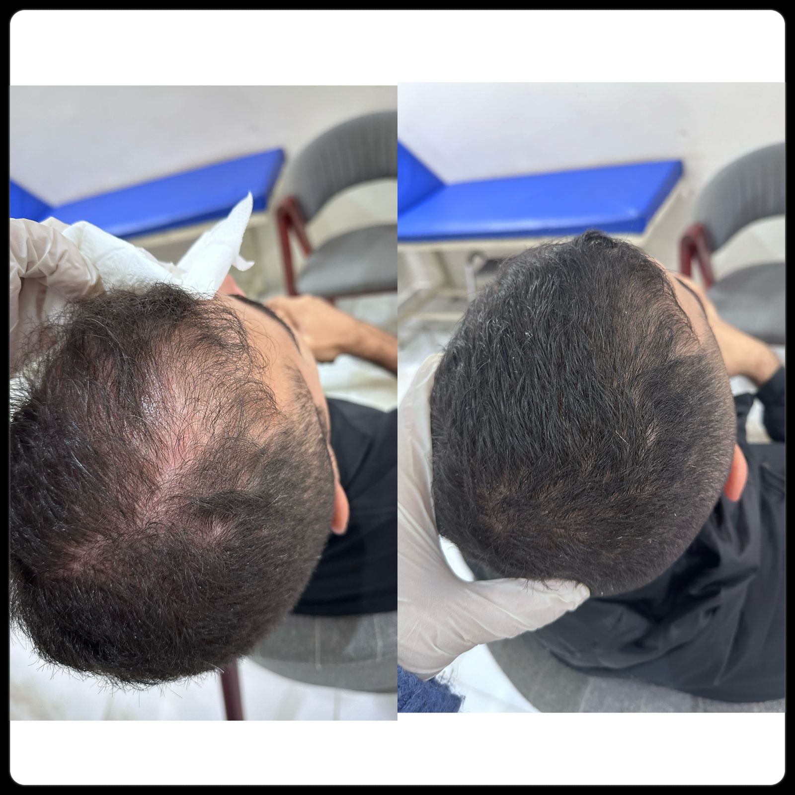 نتيجه جلسات الاكسوزوم للشعر