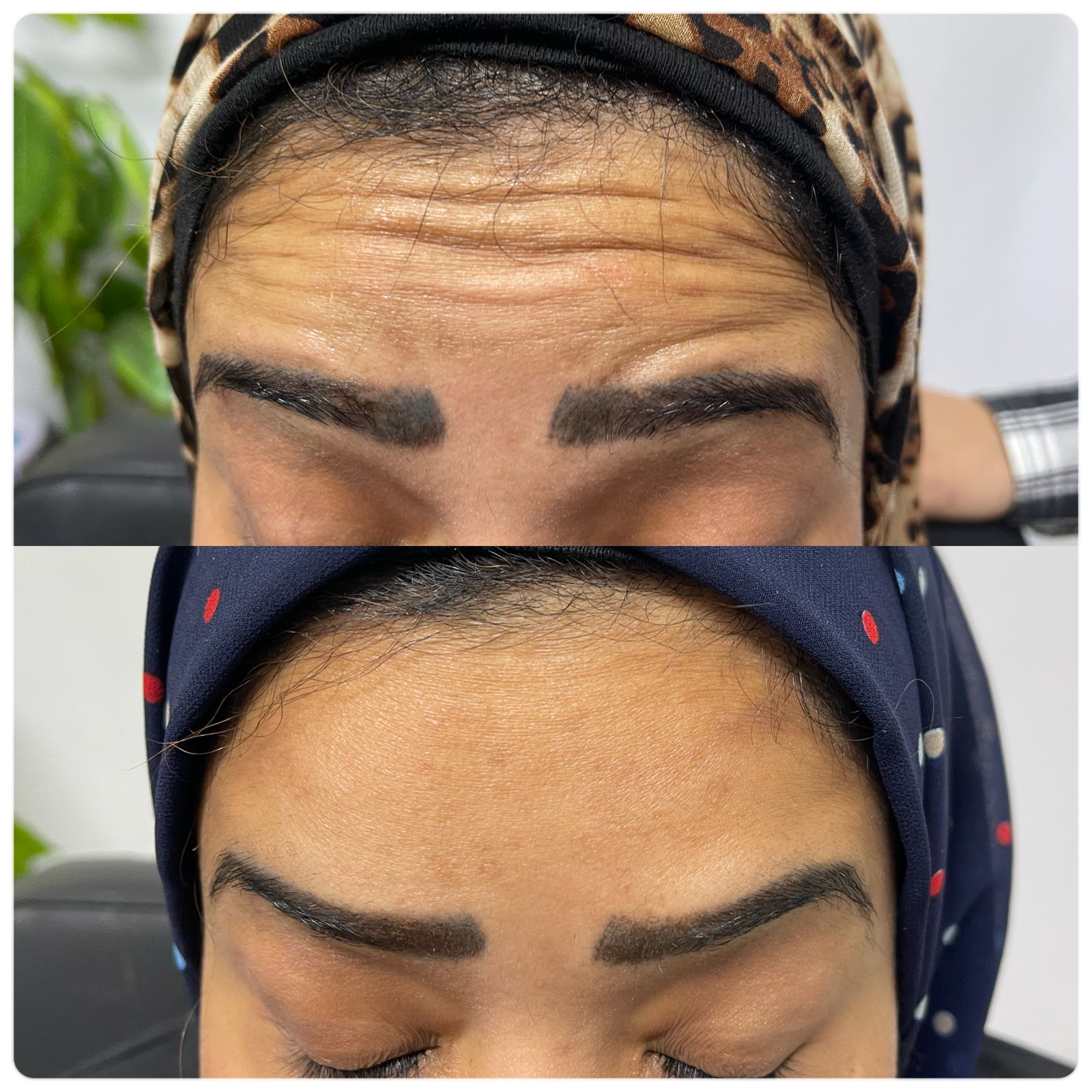 ازالة التجاعيد باستخدام البوتكس