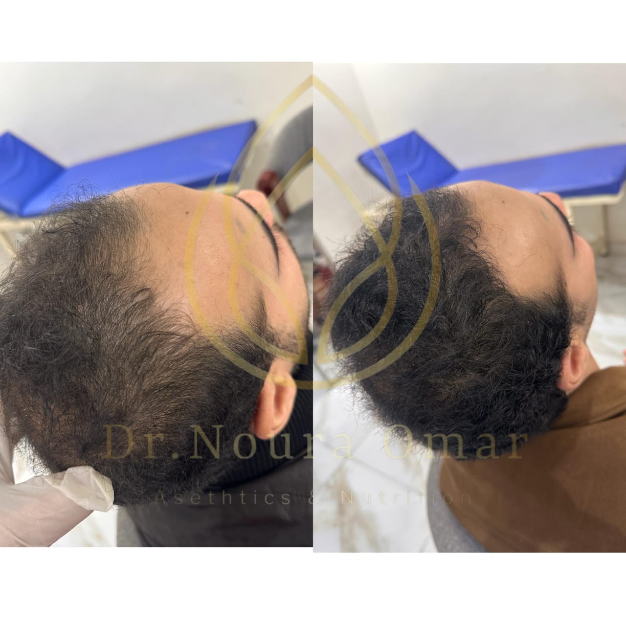 نتيجه جلسات الاكسوزوم للشعر