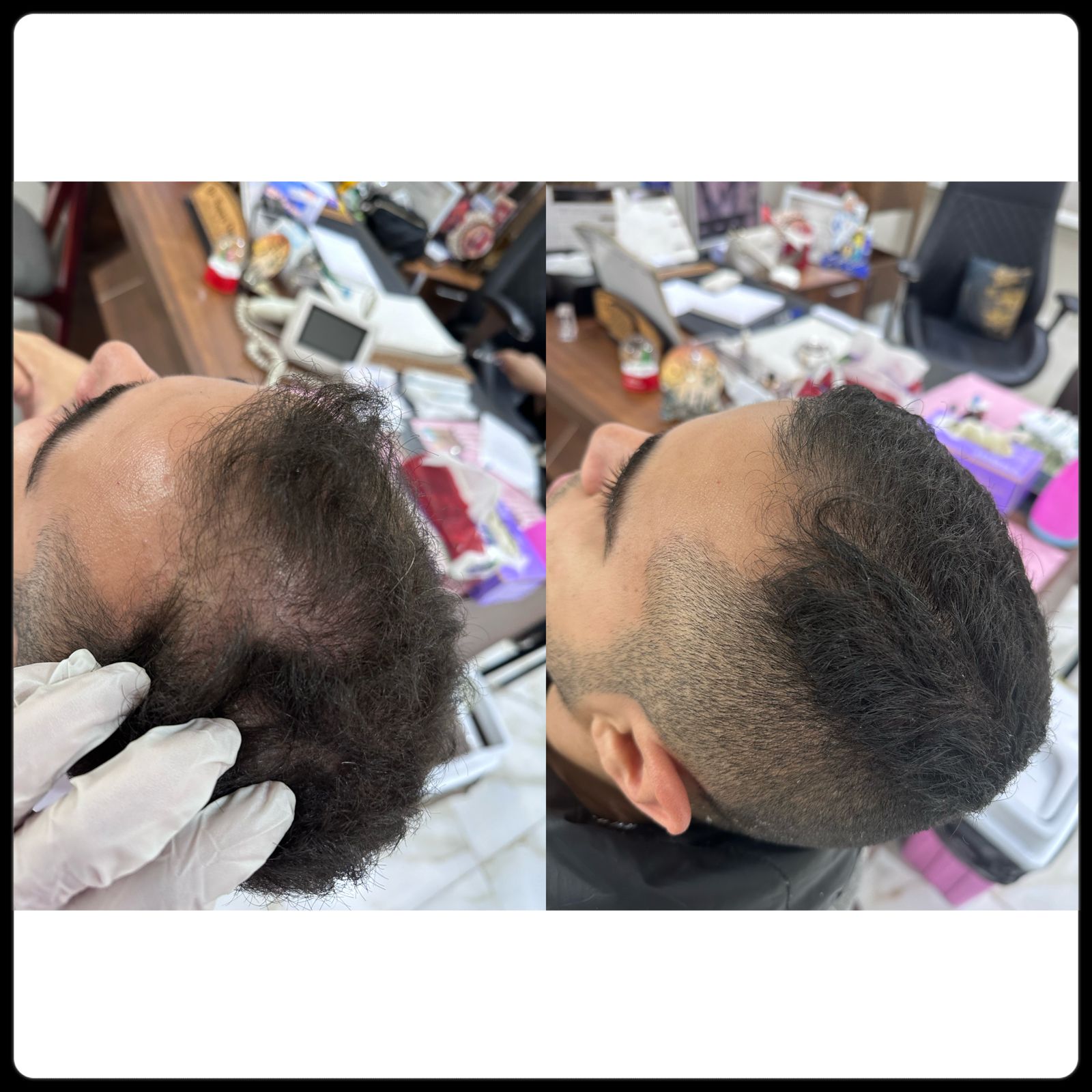 نتيجه جلسات الاكسوزوم للشعر