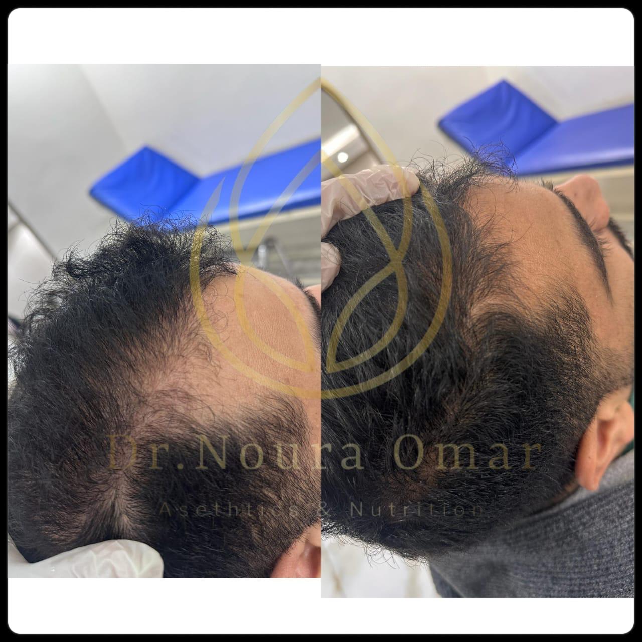 نتيجه جلسات الاكسوزوم للشعر